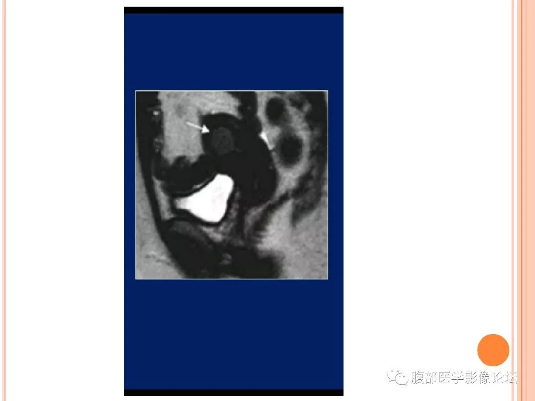 【病例】子宫内膜息肉1例MR影像