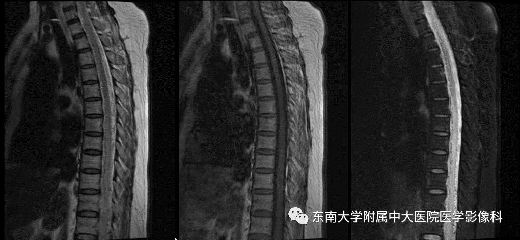 【病例】硬脊膜动静脉瘘1例MR影像