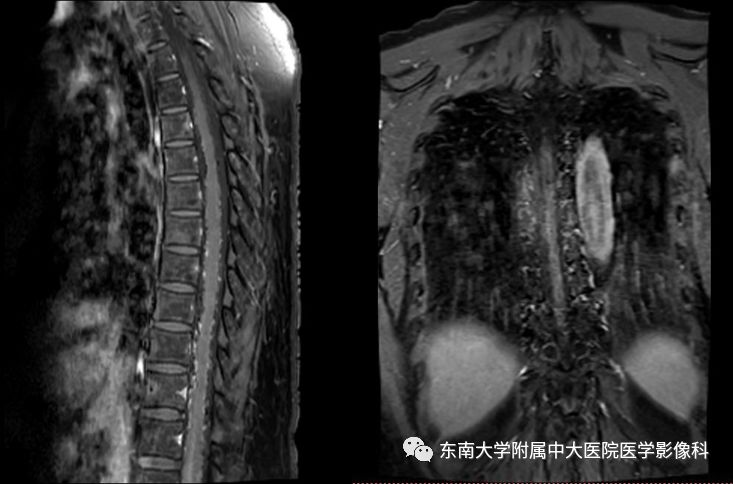 【病例】硬脊膜动静脉瘘1例MR影像
