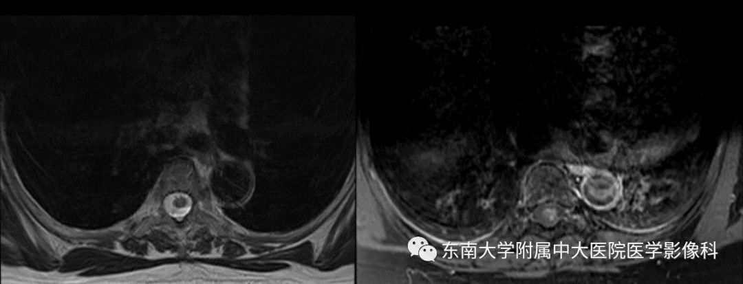 【病例】硬脊膜动静脉瘘1例MR影像