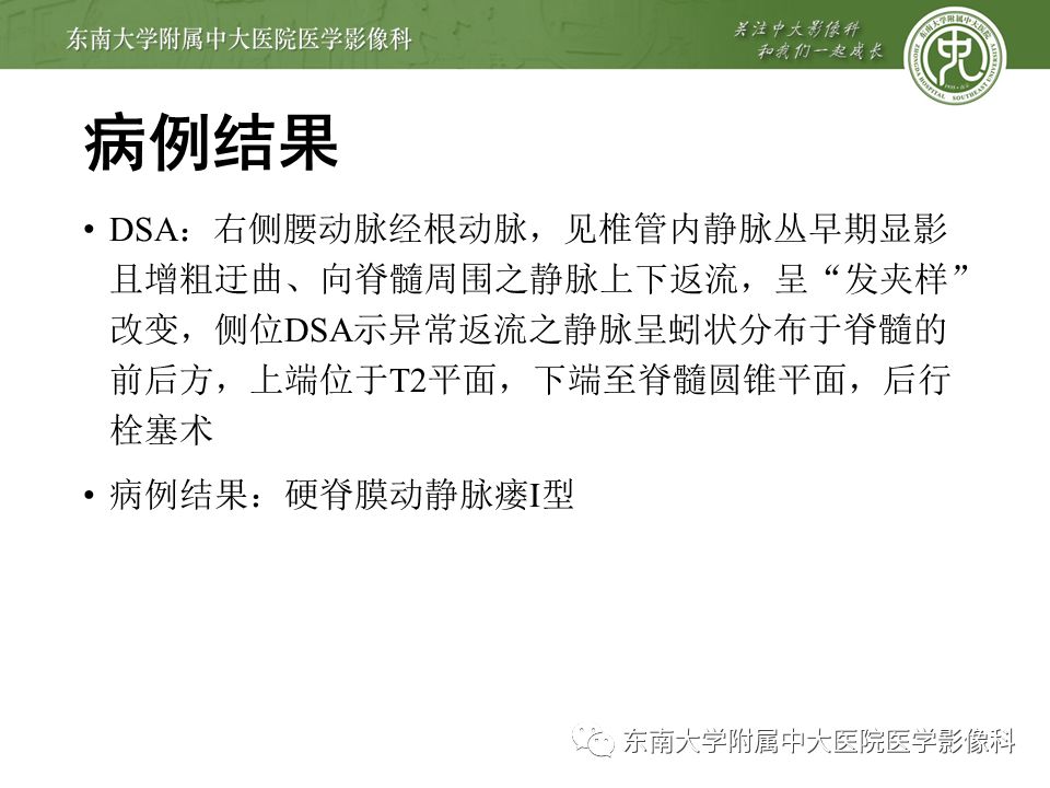 【病例】硬脊膜动静脉瘘1例MR影像