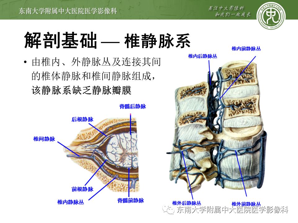 【病例】硬脊膜动静脉瘘1例MR影像
