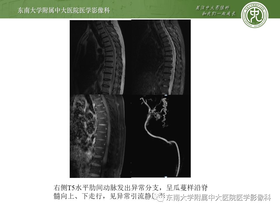 【病例】硬脊膜动静脉瘘1例MR影像