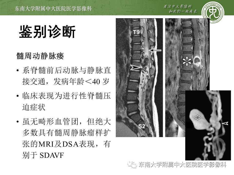 【病例】硬脊膜动静脉瘘1例MR影像