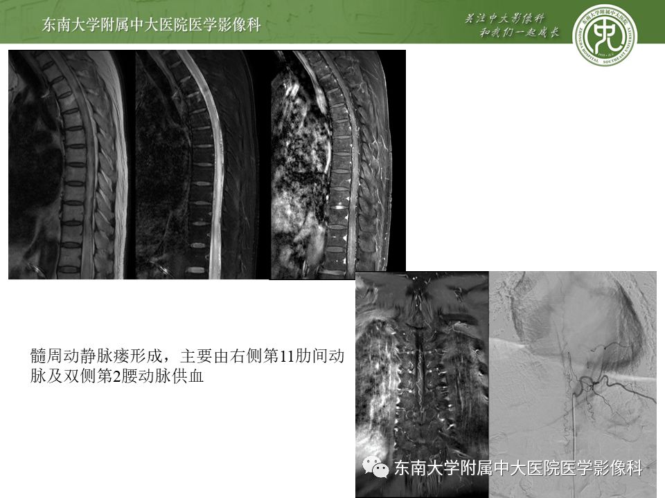 【病例】硬脊膜动静脉瘘1例MR影像