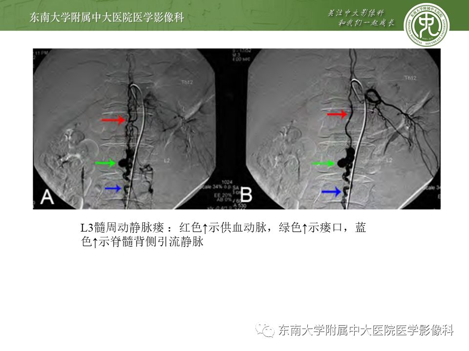 【病例】硬脊膜动静脉瘘1例MR影像