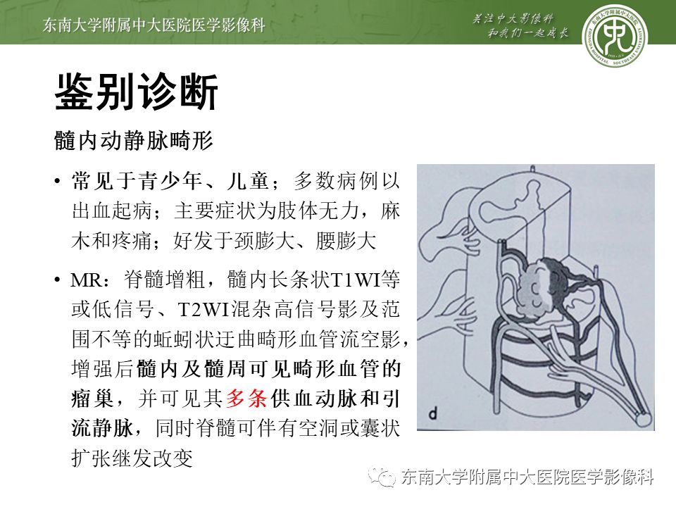 【病例】硬脊膜动静脉瘘1例MR影像
