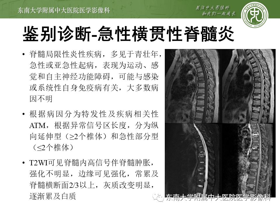 【病例】硬脊膜动静脉瘘1例MR影像
