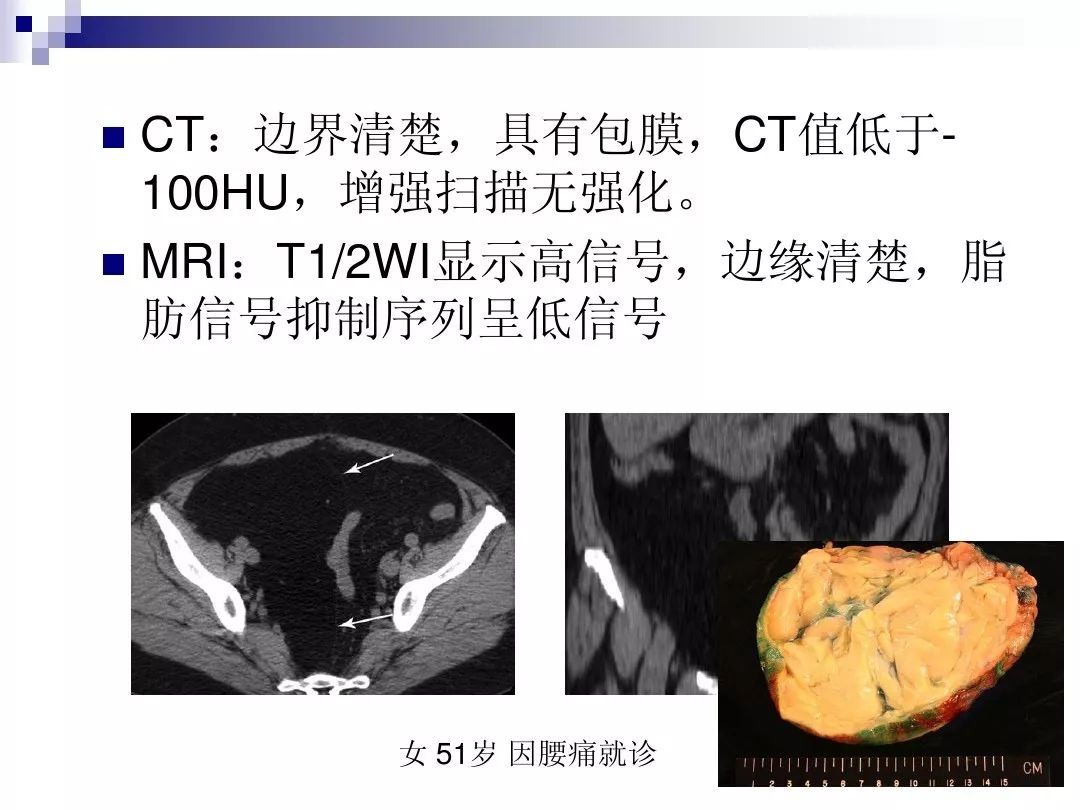【PPT】腹膜后含脂肪成分肿瘤或肿瘤样病变