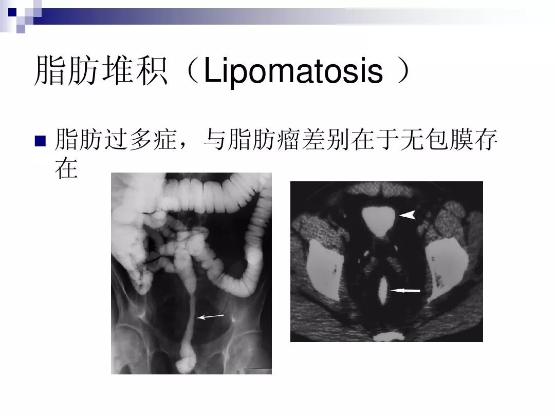 【PPT】腹膜后含脂肪成分肿瘤或肿瘤样病变