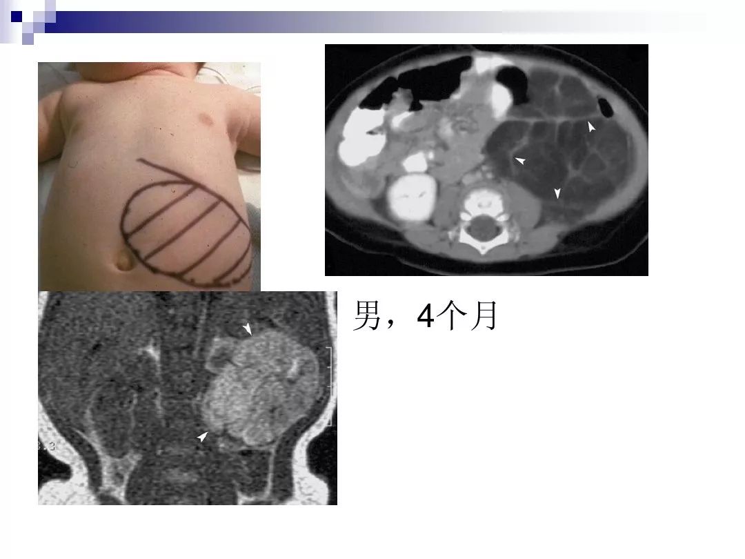 【PPT】腹膜后含脂肪成分肿瘤或肿瘤样病变