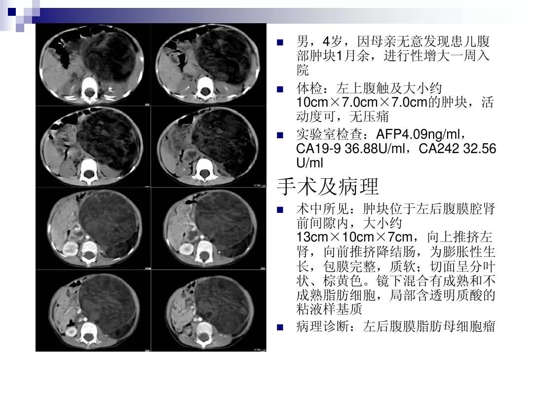 【PPT】腹膜后含脂肪成分肿瘤或肿瘤样病变