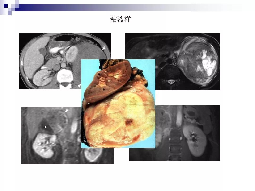 【PPT】腹膜后含脂肪成分肿瘤或肿瘤样病变