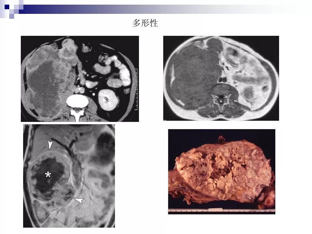 【PPT】腹膜后含脂肪成分肿瘤或肿瘤样病变