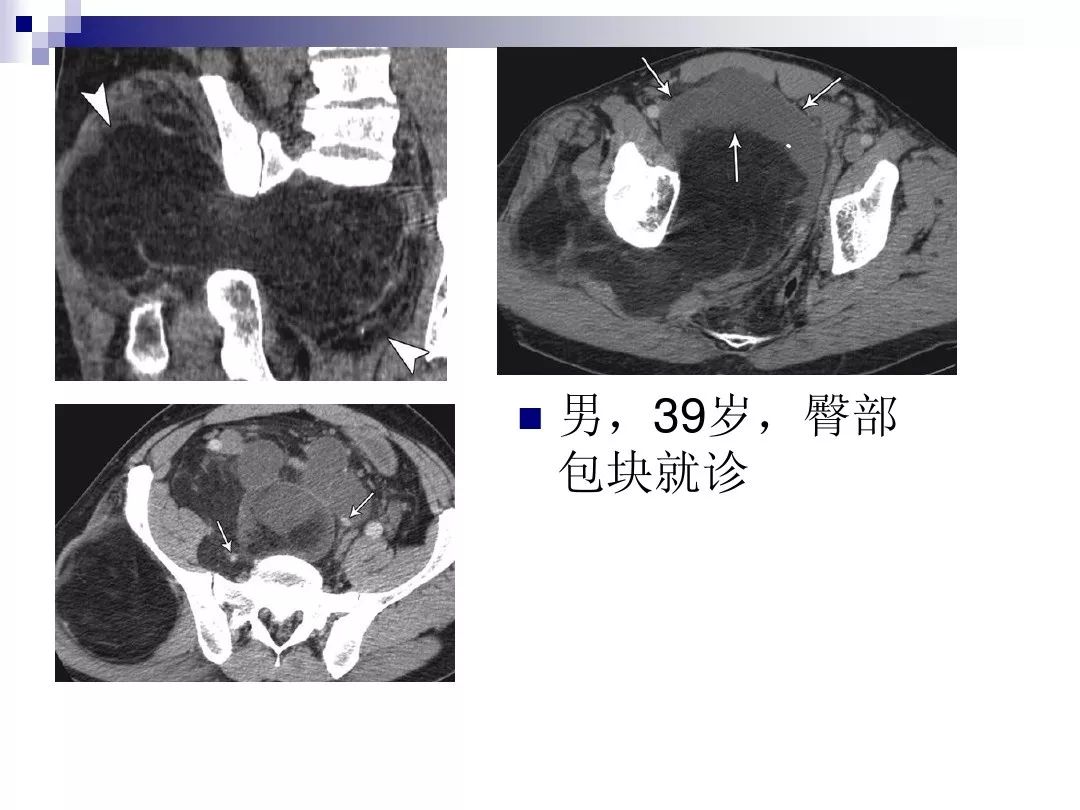 【PPT】腹膜后含脂肪成分肿瘤或肿瘤样病变