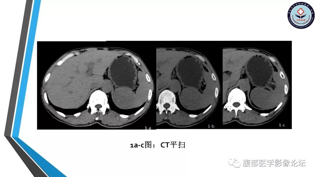 【PPT】脾脏硬化性血管瘤结节样转化