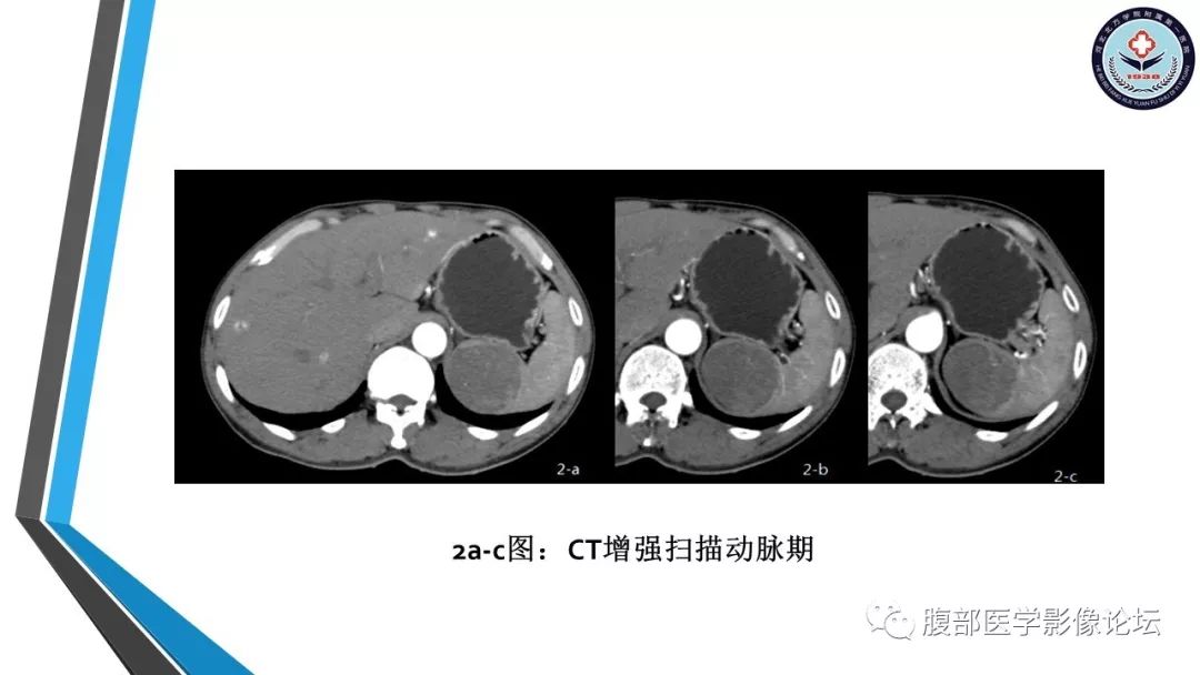 【PPT】脾脏硬化性血管瘤结节样转化