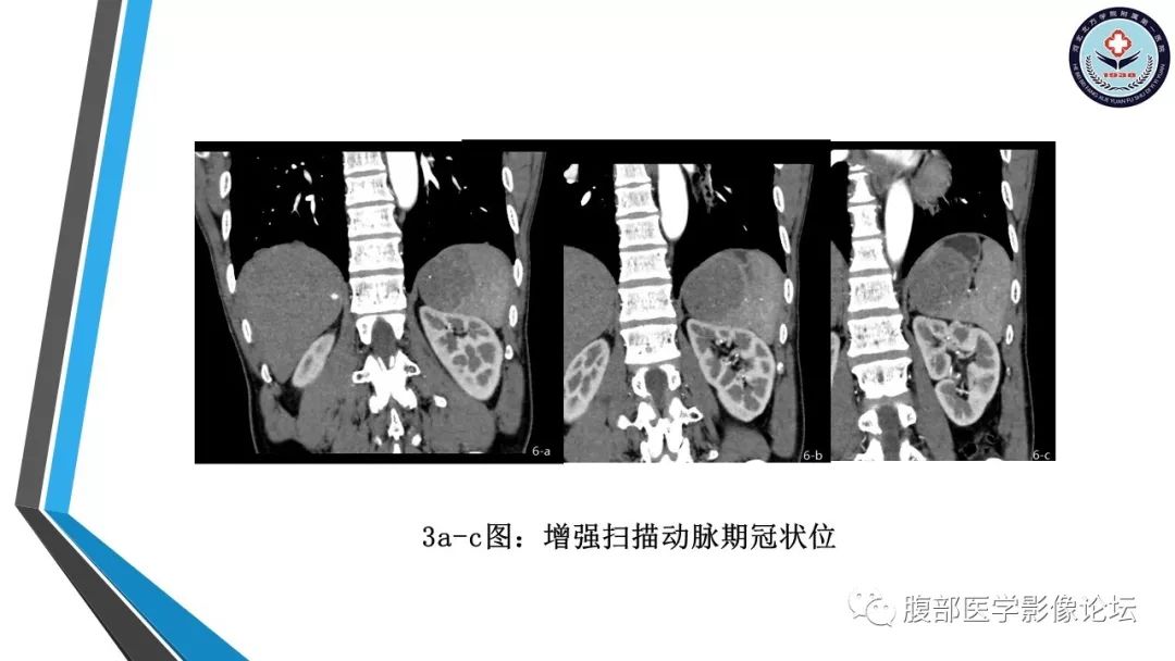 【PPT】脾脏硬化性血管瘤结节样转化