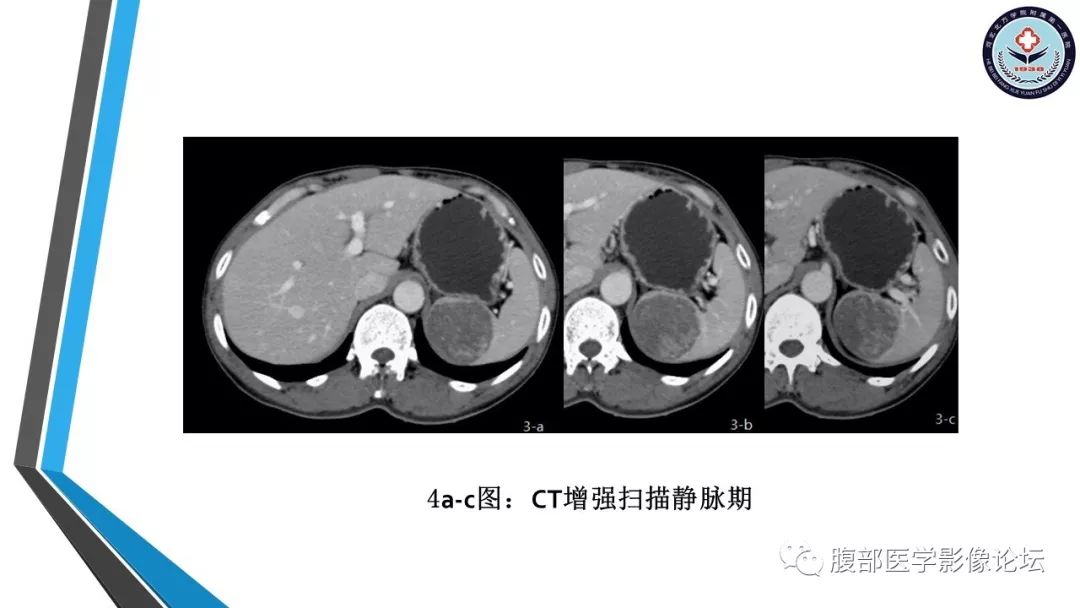 【PPT】脾脏硬化性血管瘤结节样转化