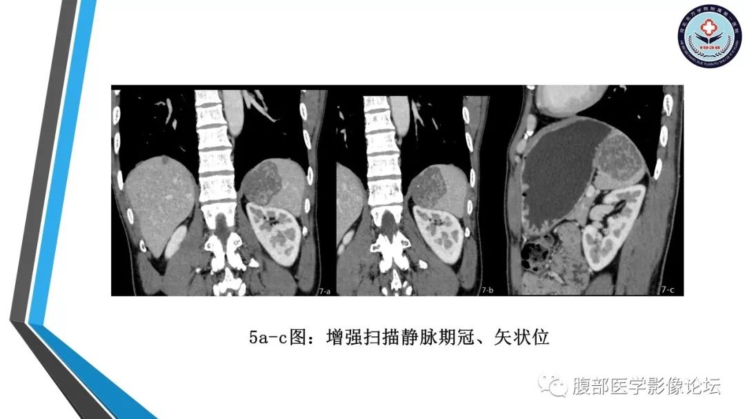 【PPT】脾脏硬化性血管瘤结节样转化