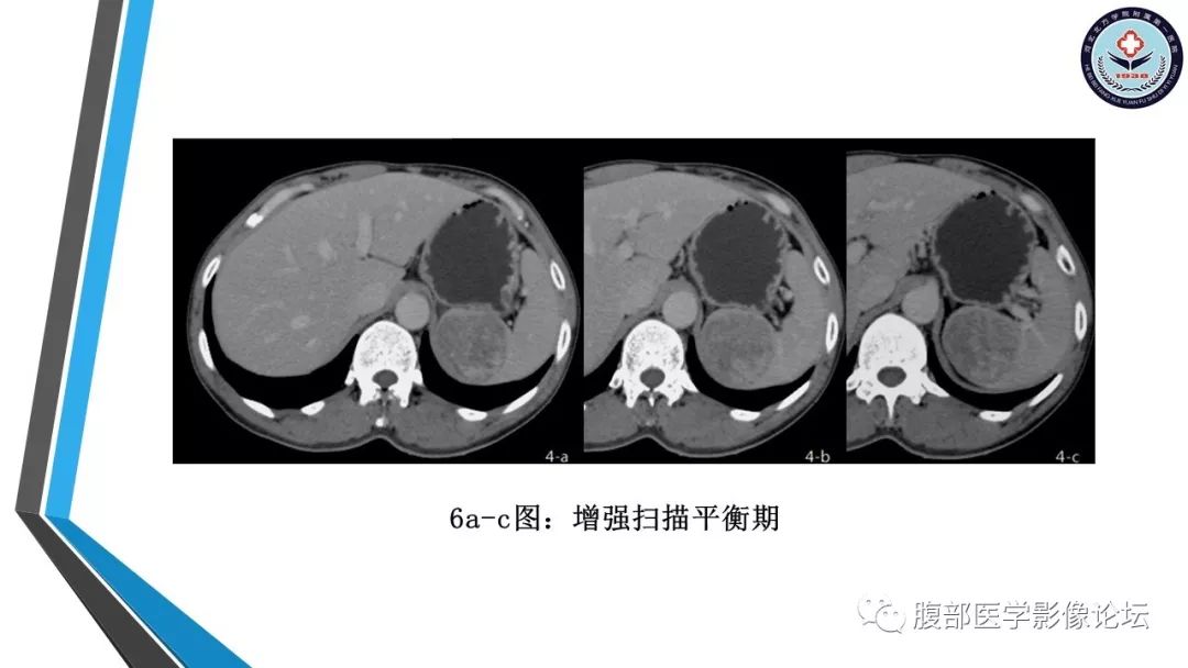 【PPT】脾脏硬化性血管瘤结节样转化