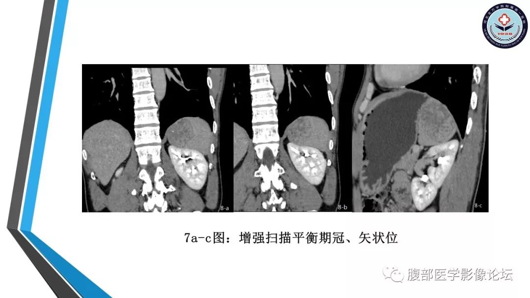 【PPT】脾脏硬化性血管瘤结节样转化