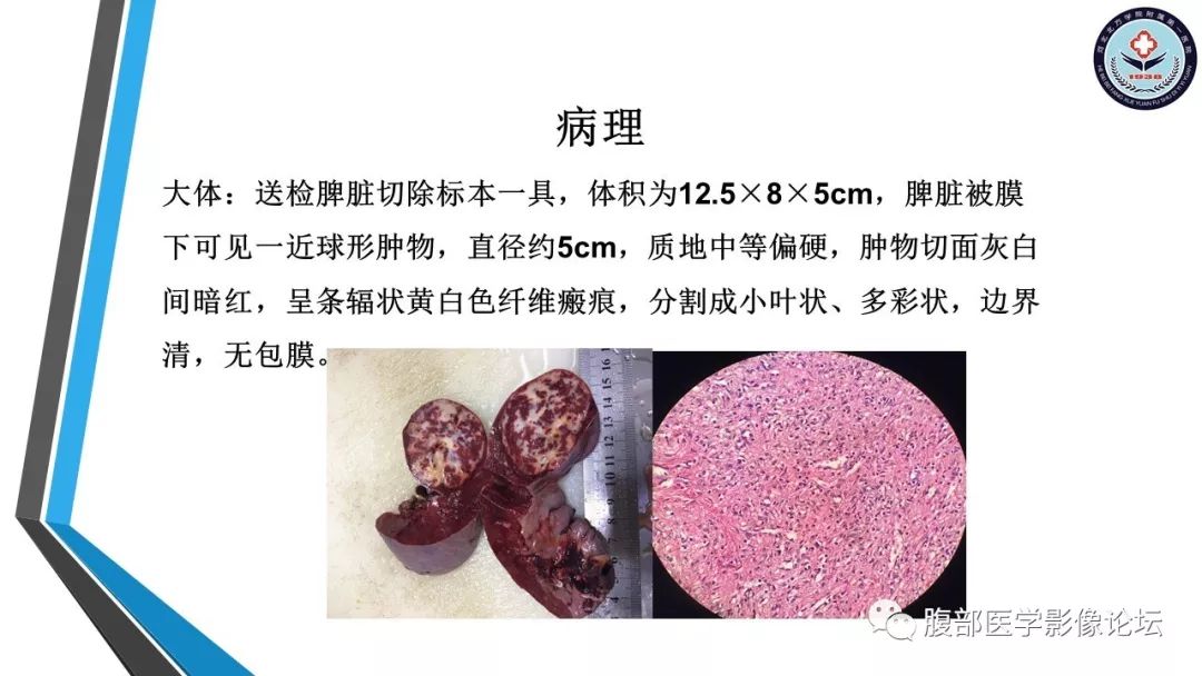 【PPT】脾脏硬化性血管瘤结节样转化