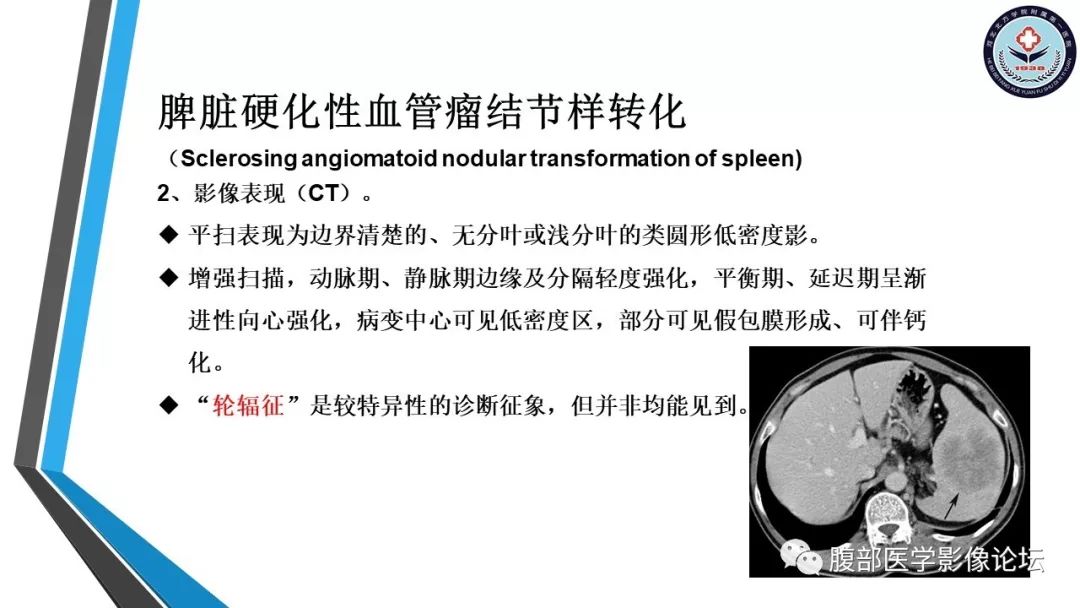 【PPT】脾脏硬化性血管瘤结节样转化