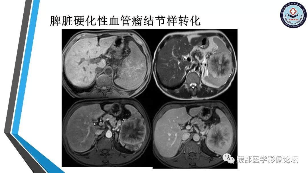 【PPT】脾脏硬化性血管瘤结节样转化