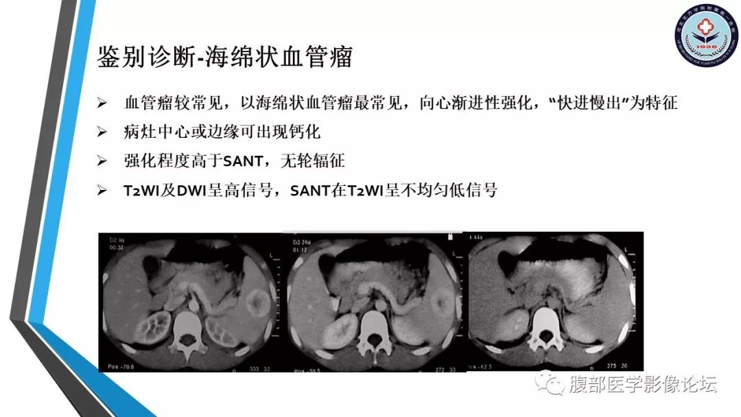 【PPT】脾脏硬化性血管瘤结节样转化