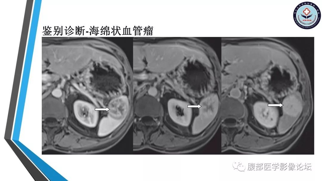 【PPT】脾脏硬化性血管瘤结节样转化