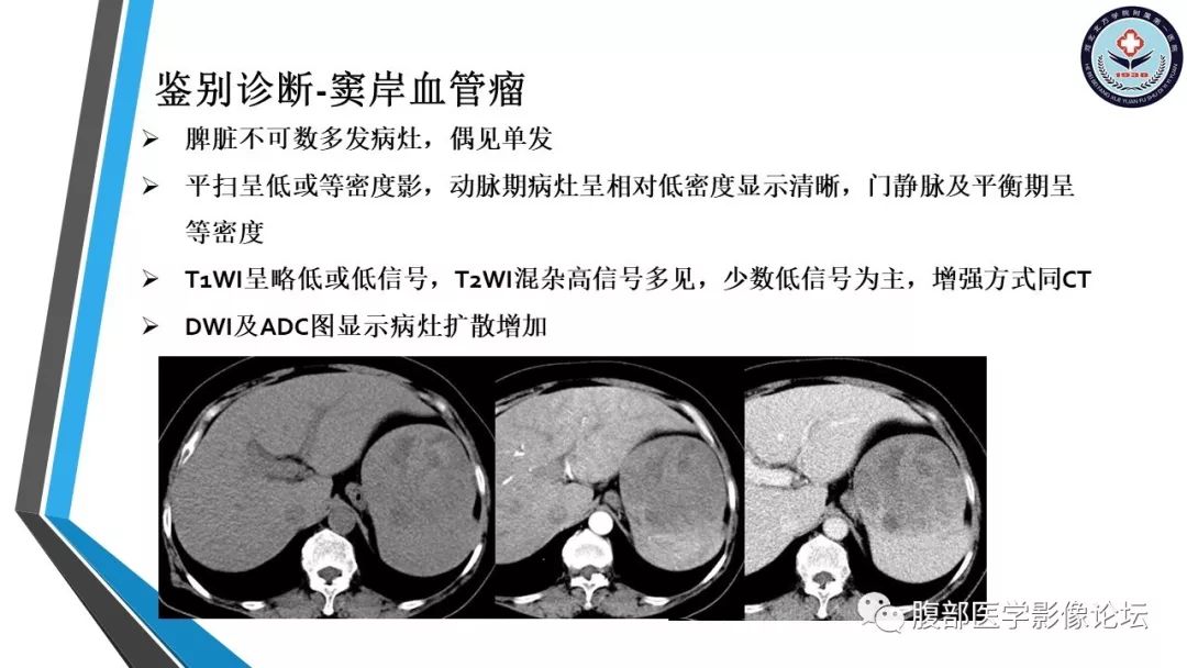 【PPT】脾脏硬化性血管瘤结节样转化
