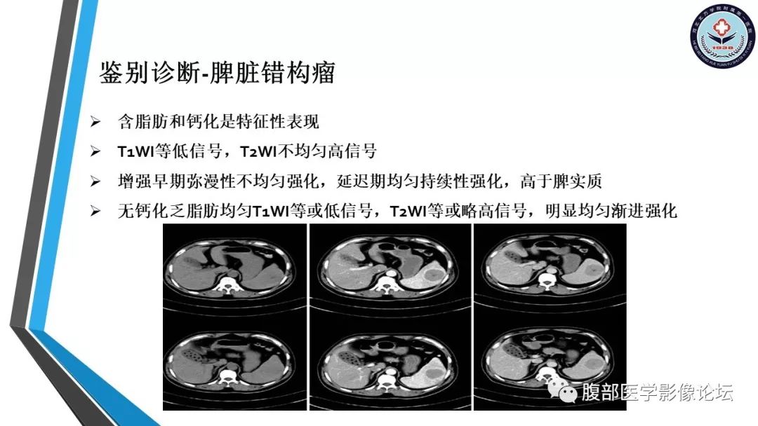 【PPT】脾脏硬化性血管瘤结节样转化
