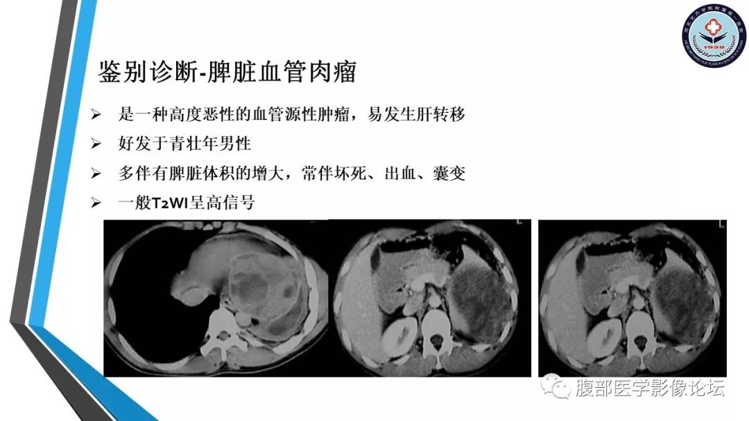 【PPT】脾脏硬化性血管瘤结节样转化