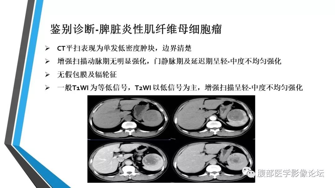【PPT】脾脏硬化性血管瘤结节样转化