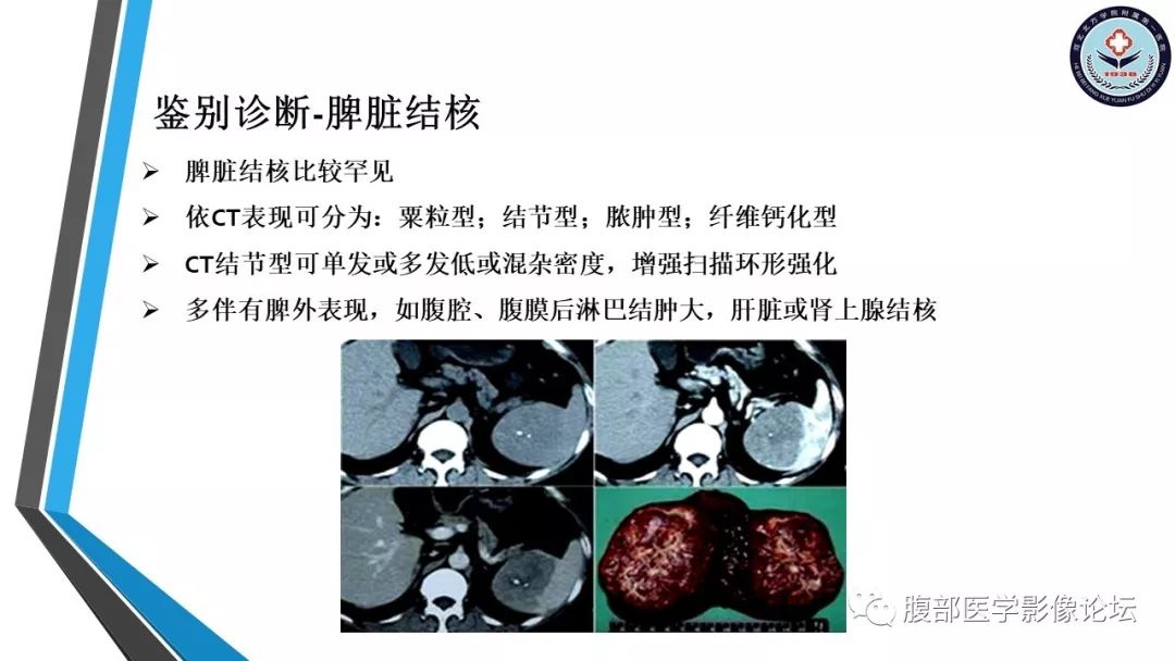 【PPT】脾脏硬化性血管瘤结节样转化