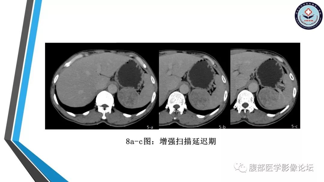 【PPT】脾脏硬化性血管瘤结节样转化