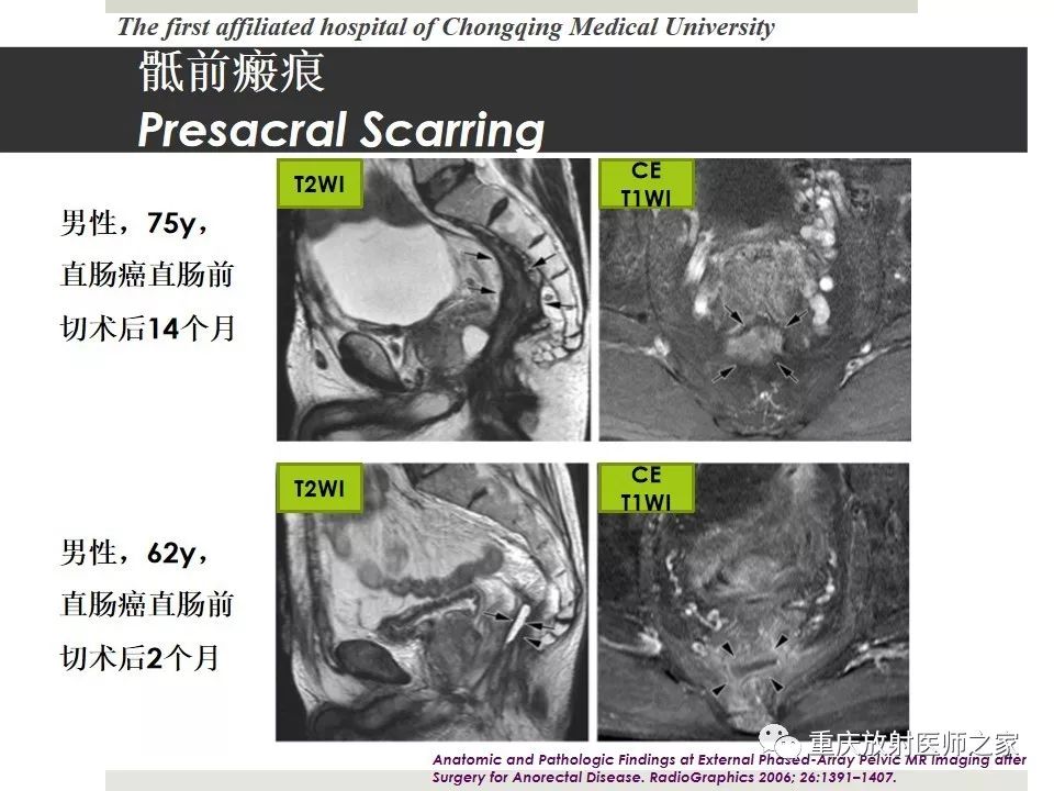 【PPT】胃肠道肿瘤术后影像报告