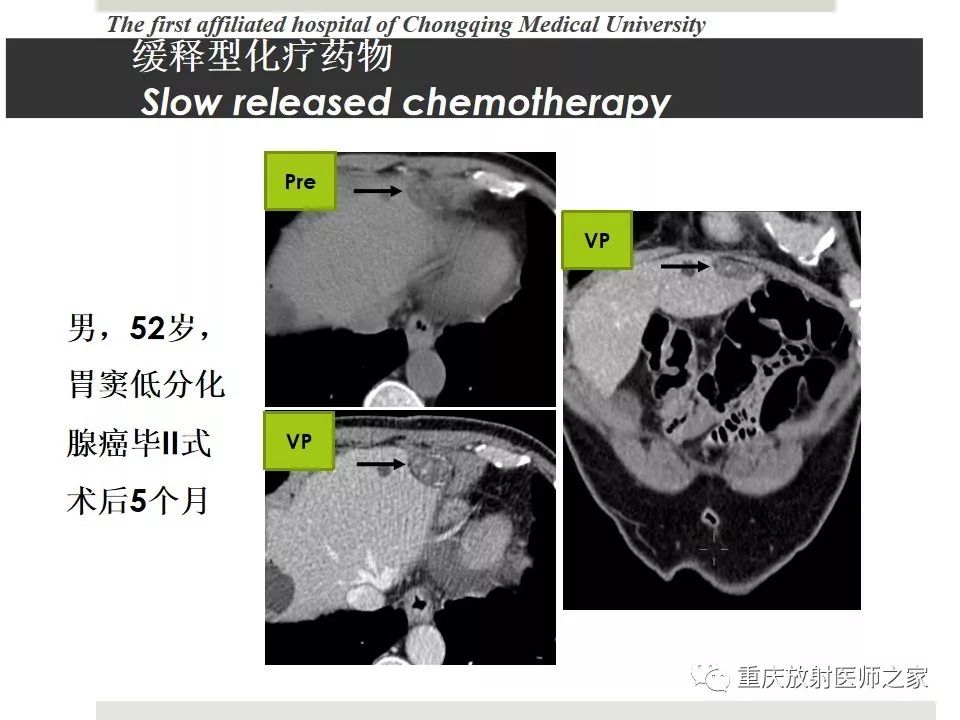 【PPT】胃肠道肿瘤术后影像报告