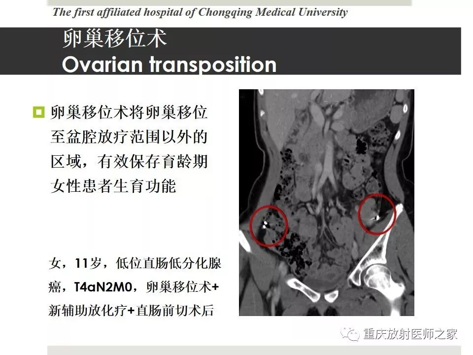 【PPT】胃肠道肿瘤术后影像报告