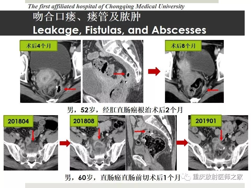 【PPT】胃肠道肿瘤术后影像报告