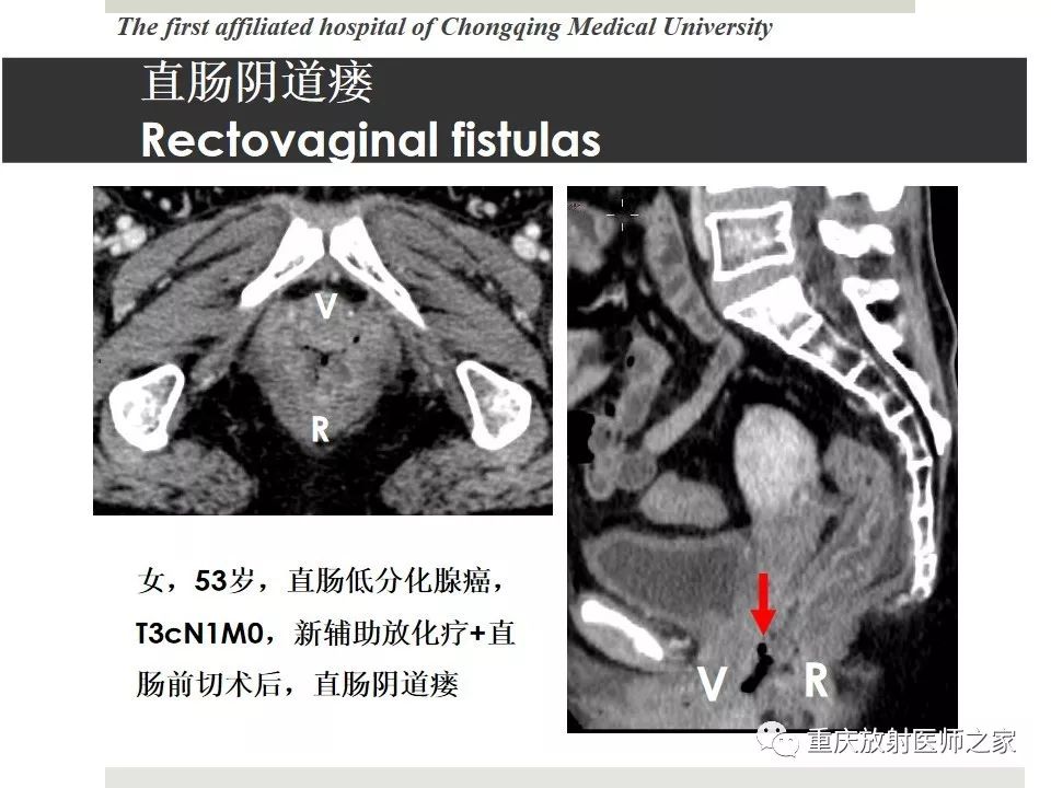 【PPT】胃肠道肿瘤术后影像报告