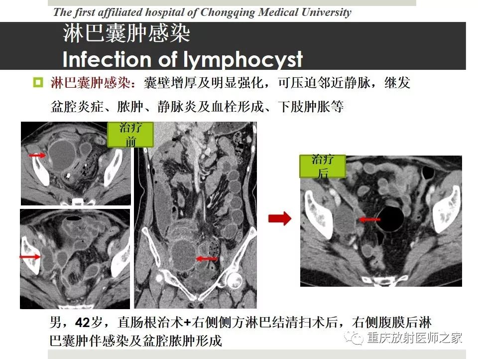 【PPT】胃肠道肿瘤术后影像报告