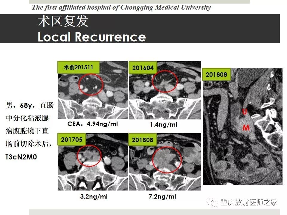 【PPT】胃肠道肿瘤术后影像报告