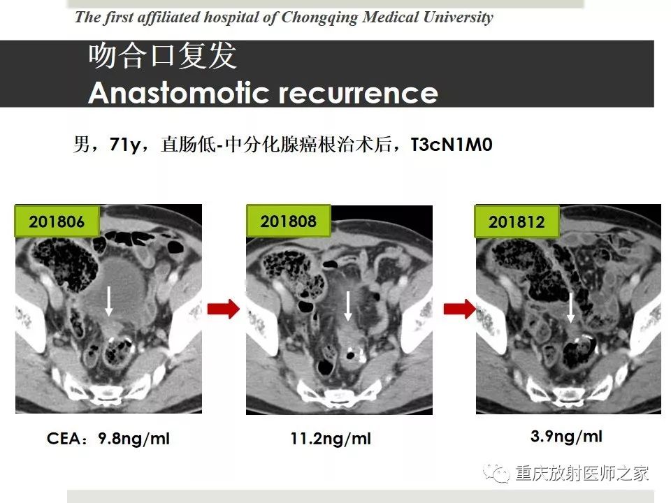 【PPT】胃肠道肿瘤术后影像报告