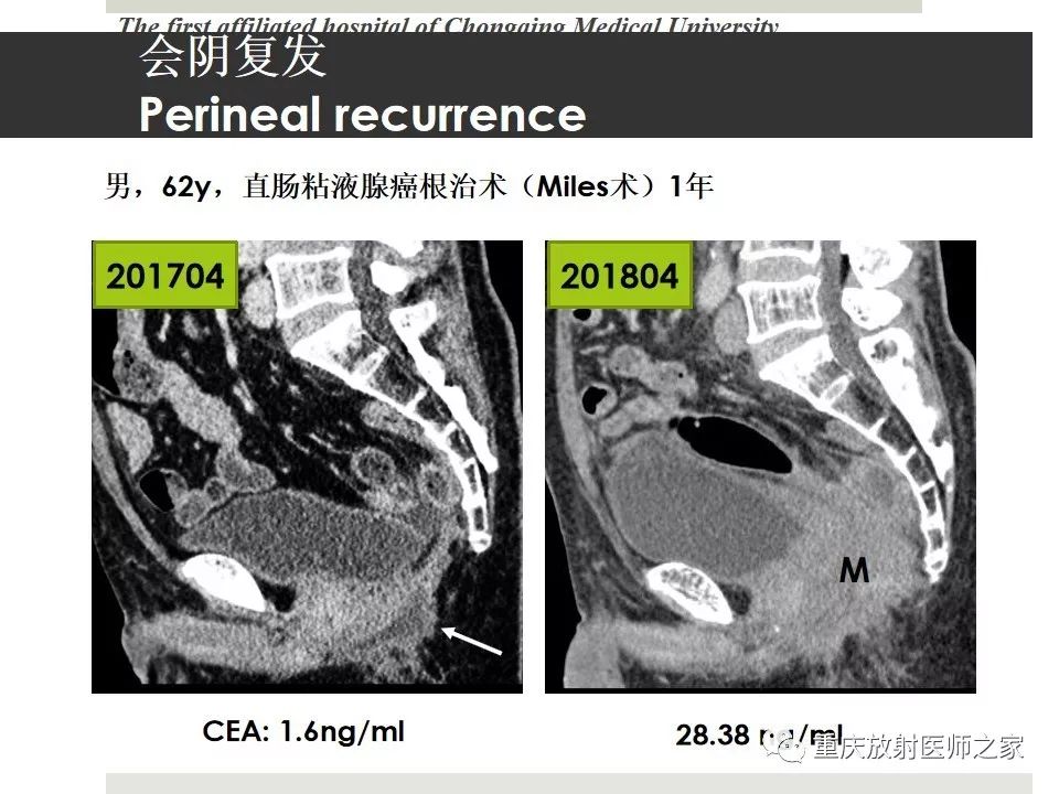 【PPT】胃肠道肿瘤术后影像报告