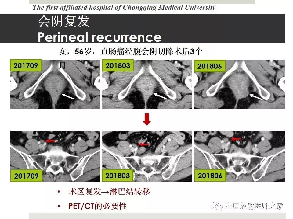 【PPT】胃肠道肿瘤术后影像报告