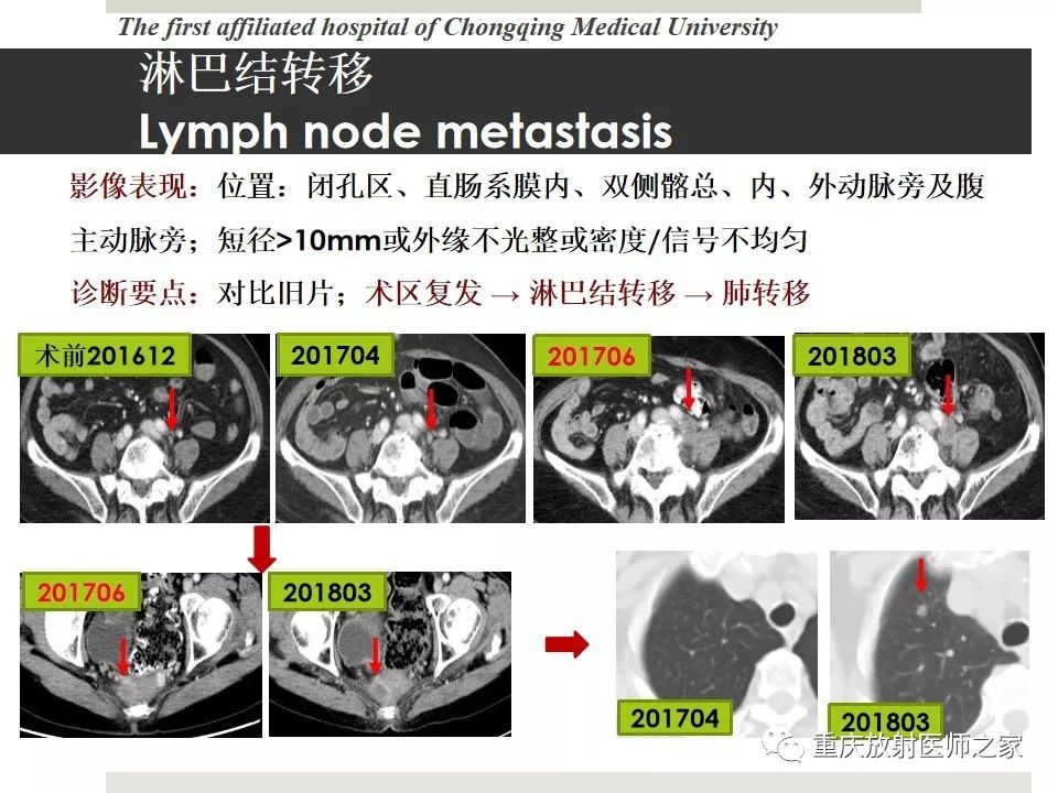 【PPT】胃肠道肿瘤术后影像报告