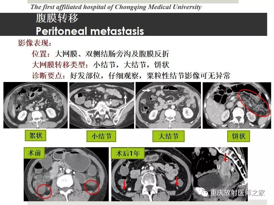 【PPT】胃肠道肿瘤术后影像报告