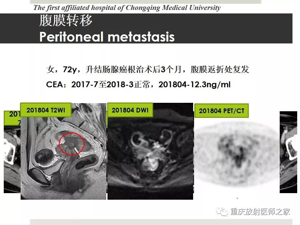 【PPT】胃肠道肿瘤术后影像报告
